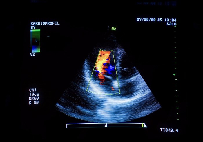 Ultrasound scan of a person's heart, visualised on a computer screen.