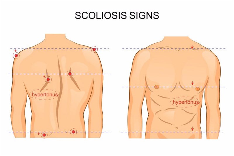 What are the symptoms, risk factors and complications of scoliosis?