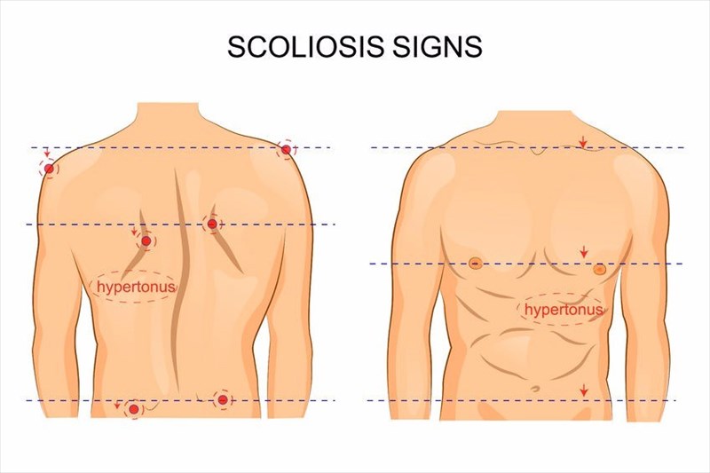 Scoliosis symptoms