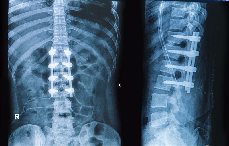 How is scoliosis treated?
