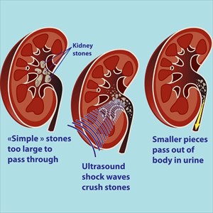 Illustrations showing the crushing of kidney stones by ultrasonic waves.