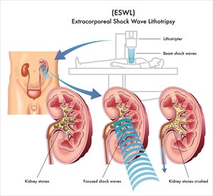 Illustration showing the process of extracorporeal shock wave lithotripsy for the treatment of kidney stones.