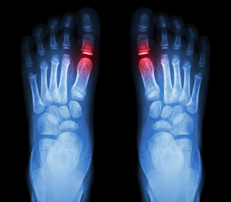 How is gout diagnosed?