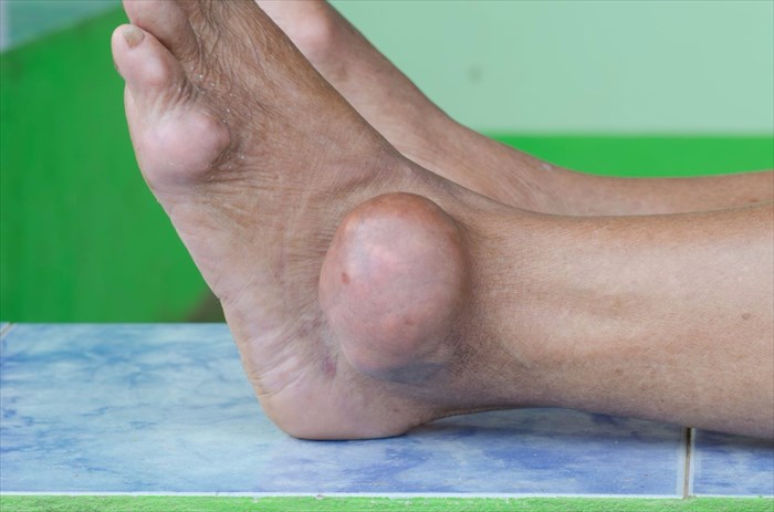 Close-up of advanced gout (formation of tophi).