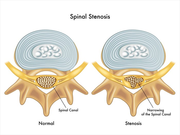 Illustrations showing the difference between normal, healthy vertebrae structures and one affected by stenosis.