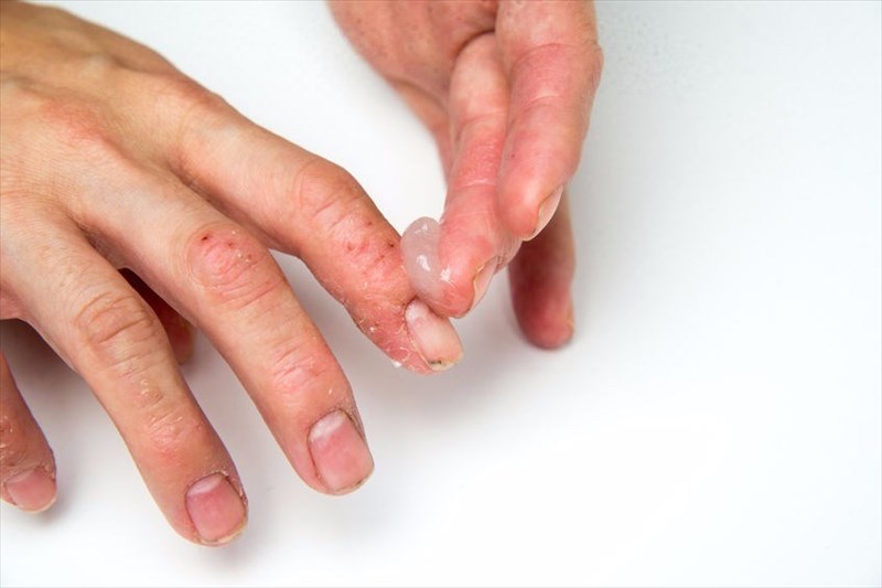 What Are The Different Types Of Eczema