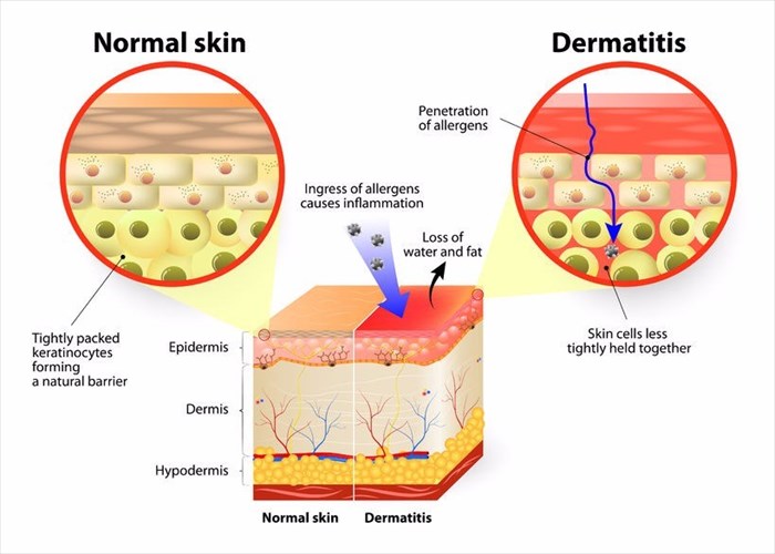 eczema vs dermatitis kiütés a testen vörös foltok formájában a kezeken