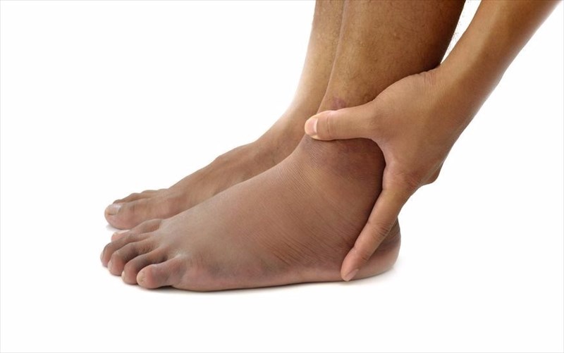 What are the complications of swollen feet and ankles?