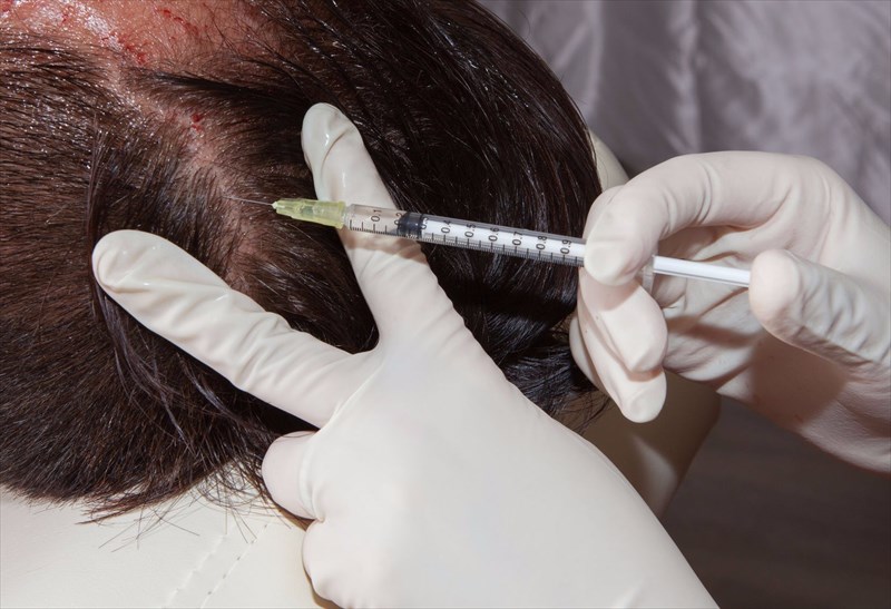 How is alopecia areata treated?