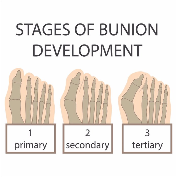 Illustration of bunion development.