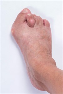 Foot of a woman with advanced stage bunion (Hallux abductus valgus).