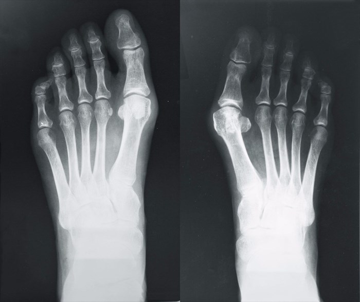 X-ray of a foot with valgus breach bones (bunion).