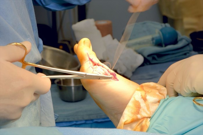Close-up of a surgeon suturing a foot after a bunionectomy.