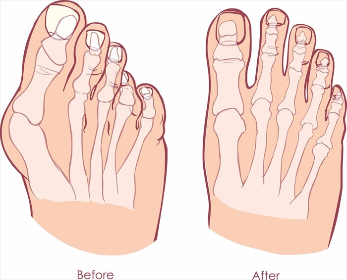 Illustration showing human foot deformity - Hallux valgus (bunion) and tailors bunion (bunionette) - before and after surgery.