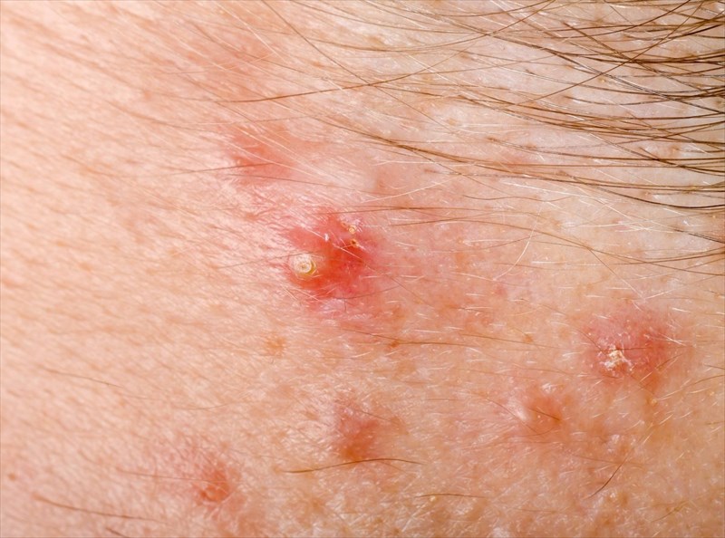 What are the signs and symptoms of folliculitis?