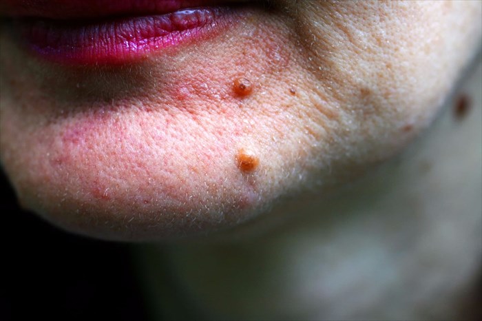 Close-up of a port wine birthmark on the chin. 