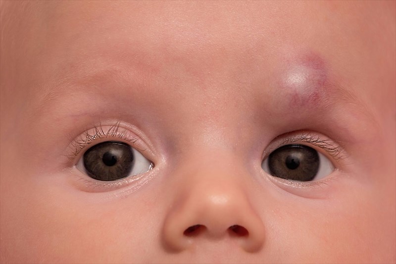 What complications are associated with birthmarks?