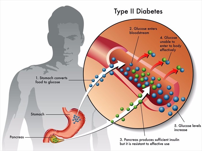 Illustration showing type 2 diabetes and how the condition affects the body.