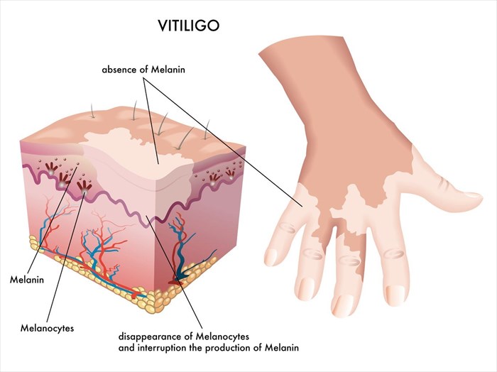 Illustration showing the mechanisms of vitiligo (pigment loss in the skin).