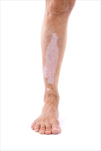 Leg of a man with vitiligo skin condition.