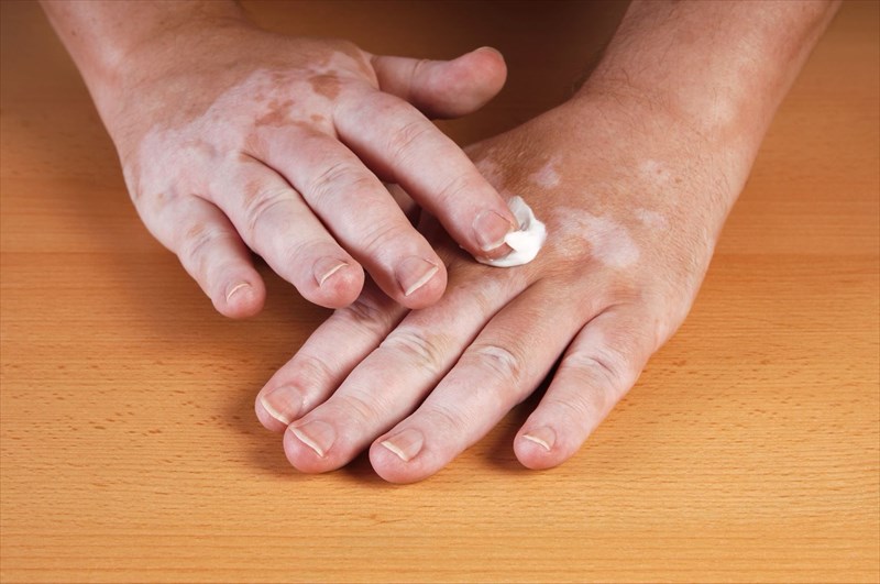 How is vitiligo treated?