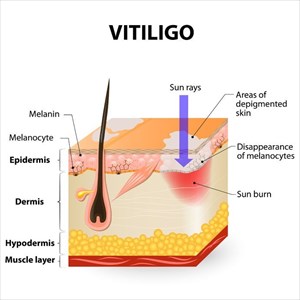 Illustration depicting how sun rays impact skin affected by vitiligo.