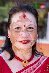 Portrait of a woman with extensive vitiligo on the face.