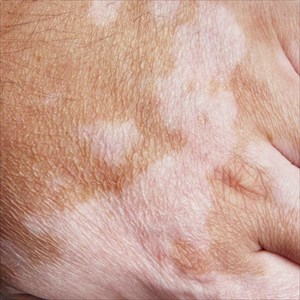 Vitiligo close-up showing depigmentation / white patches of skin.