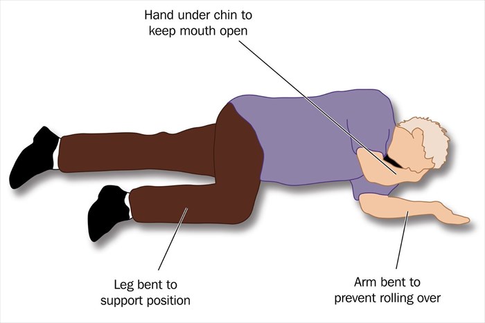 Illustration of a patient placed in the recovery position to ensure a clear airway for adequate breathing.