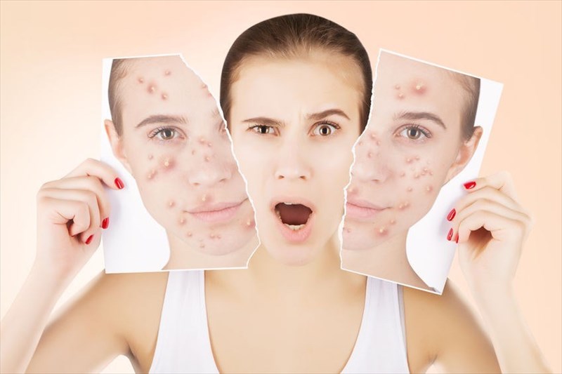 Who is a candidate for a chemical peel?