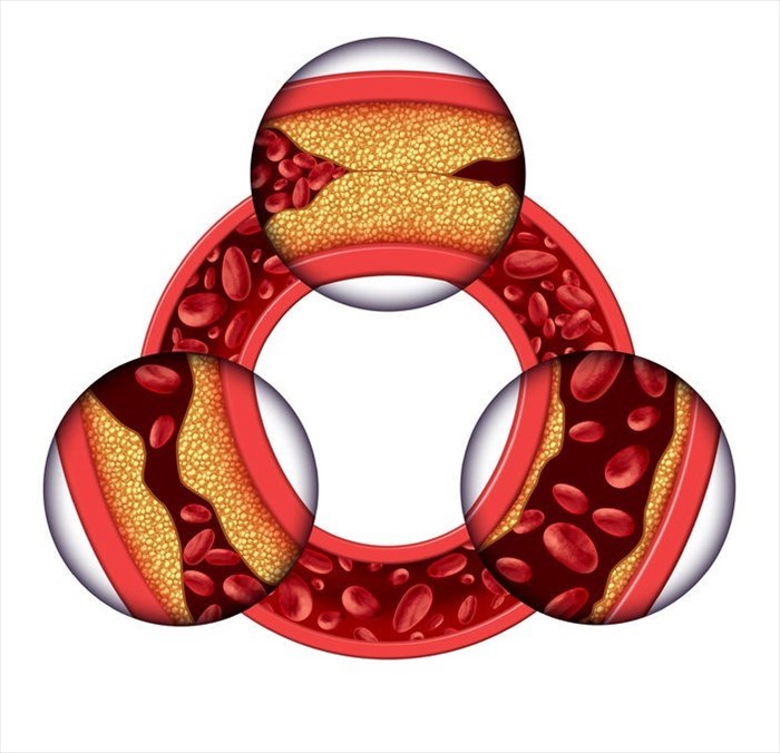 Illustration showing a circular vein with gradual plaque formation resulting in clogged arteries and atherosclerosis.