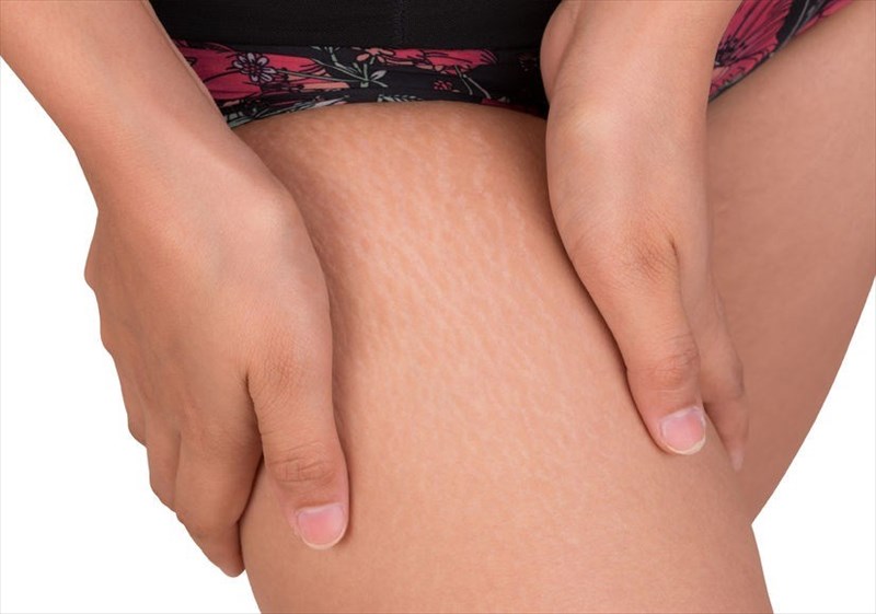 In a nutshell, how do stretch marks form?