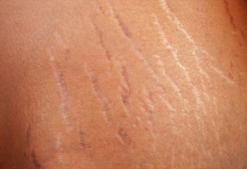 Types Of Stretch Marks