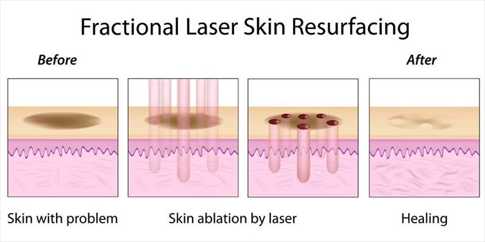 Illustration showing fractional laser skin resurfacing.