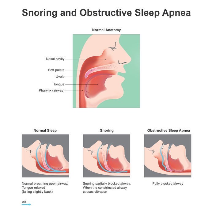 Illustration showing the vibration of respiratory structures and the resulting sound due to obstructed air movement during breathing while sleeping.