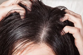 Dandruff (mild seborrheic dermatitis of the scalp)