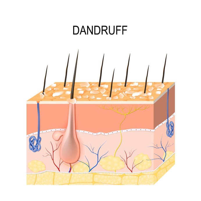 Dandruff: Causal associations