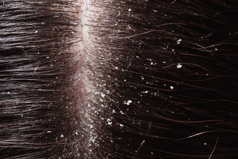 Signs and symptoms of dandruff