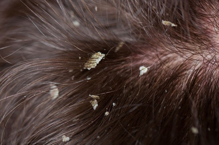 Signs and symptoms of dandruff