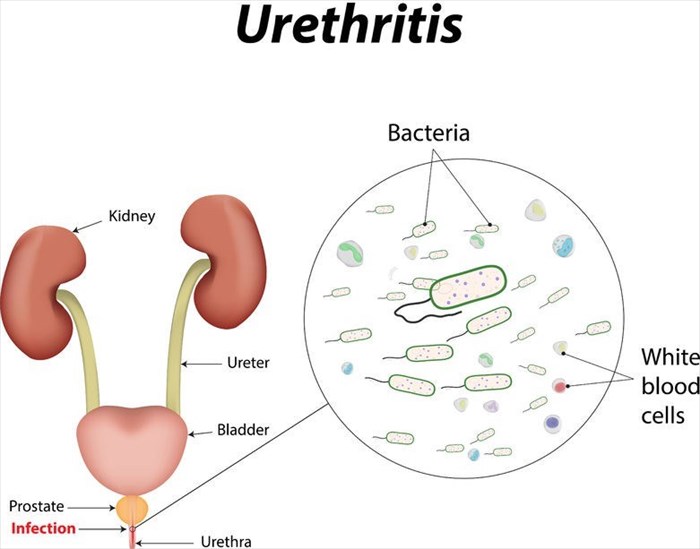 Illustration showing urethritis