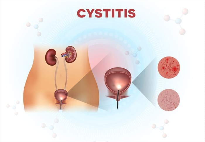 Illustration showing the urinary bladder - normal and unhealthy lining with cystitis.