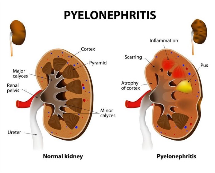 Illustration showing normal kidney and chronic pyelonephritis.