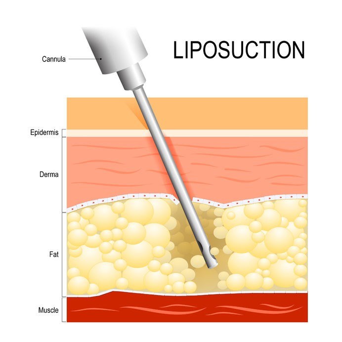 Illustration showing the process of liposuction (fat harvesting using a cannula inserted into a fat layer beneath the skin)