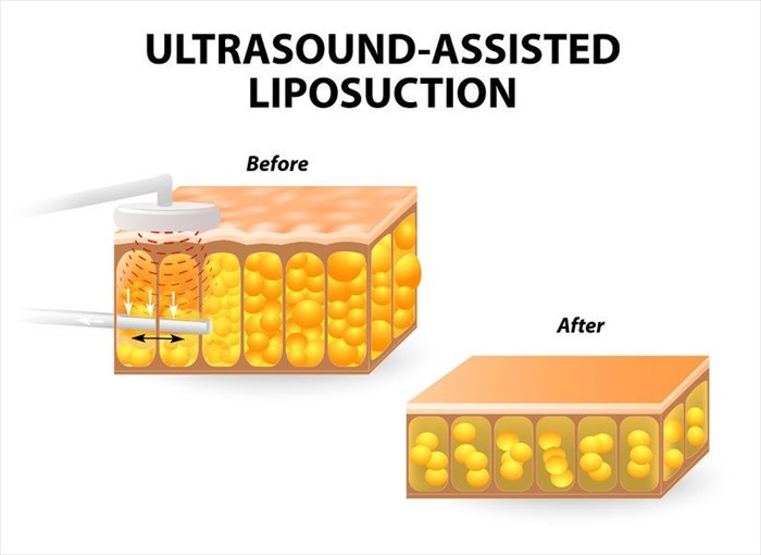 Illustration showing ultrasound-assisted liposuction as a technique option (internal and external methods).