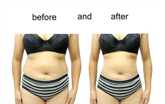Close-up showing a woman's body before and after liposuction surgery.