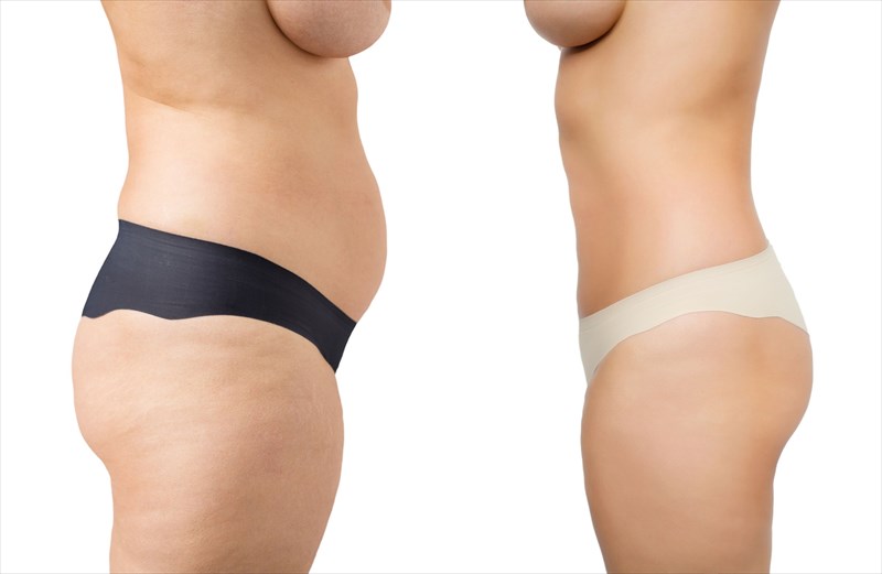 Why is liposuction performed?