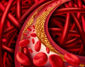 Three dimensional illustration of the human cardiovascular system showing blood cells blocked by plaque build-up (cholesterol).
