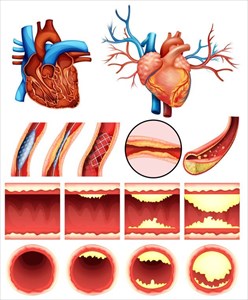 Illustration showing the impacts of plaque accumulation on the heart and cholesterol levels.