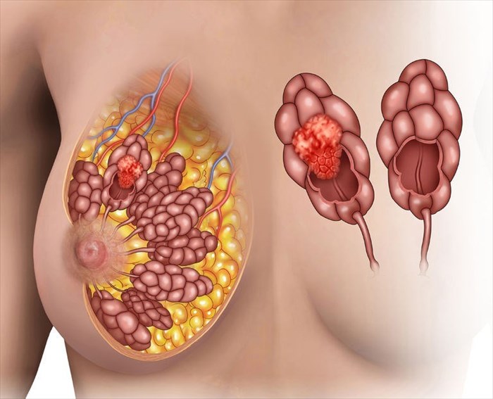 illustration depicting a tumor in the breast lobules of a woman - comparing healthy and malignant lobes.