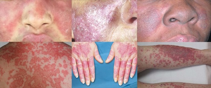 Lupus disease pictures